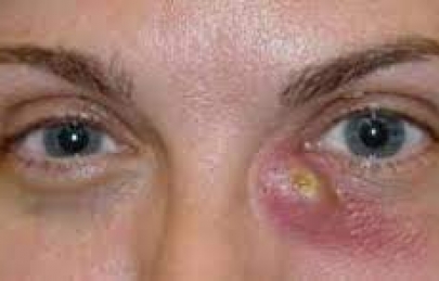 VIÊM TÚI LỆ - NGUYÊN NHÂN, TRIỆU CHỨNG VÀ PHƯƠNG PHÁP ĐIỀU TRỊ